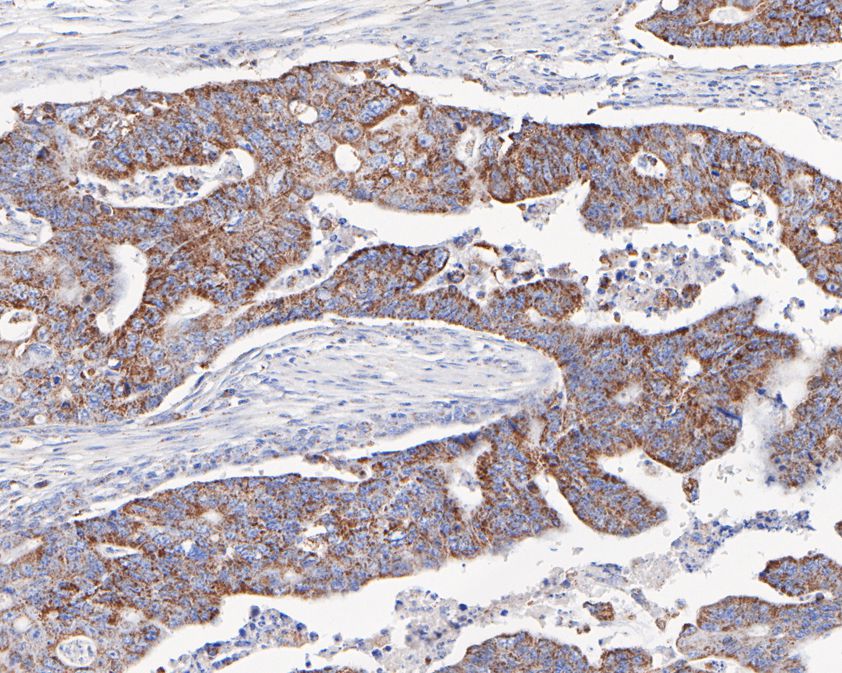 Immunohistochemical analysis of paraffin-embedded human colon carcinoma tissue using anti-GC1q R antibody. The section was pre-treated using heat mediated antigen retrieval with sodium citrate buffer (pH 6.0) for 20 minutes. The tissues were blocked in 5% BSA for 30 minutes at room temperature, washed with ddH2O and PBS, and then probed with the primary antibody (HA720078, 1/200)  for 30 minutes at room temperature. The detection was performed using an HRP conjugated compact polymer system. DAB was used as the chromogen. Tissues were counterstained with hematoxylin and mounted with DPX.