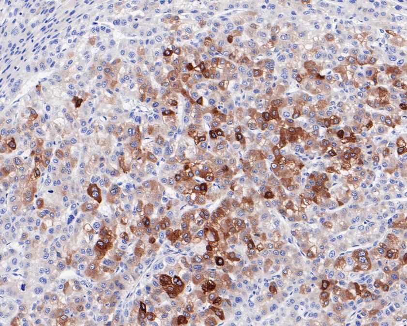 Immunohistochemical analysis of paraffin-embedded human liver carcinoma tissue using anti-FDFT1 antibody. The section was pre-treated using heat mediated antigen retrieval with Tris-EDTA buffer (pH 9.0) for 20 minutes.The tissues were blocked in 5% BSA for 30 minutes at room temperature, washed with ddH2O and PBS, and then probed with the primary antibody (HA720048, 1/50) for 30 minutes at room temperature. The detection was performed using an HRP conjugated compact polymer system. DAB was used as the chromogen. Tissues were counterstained with hematoxylin and mounted with DPX.