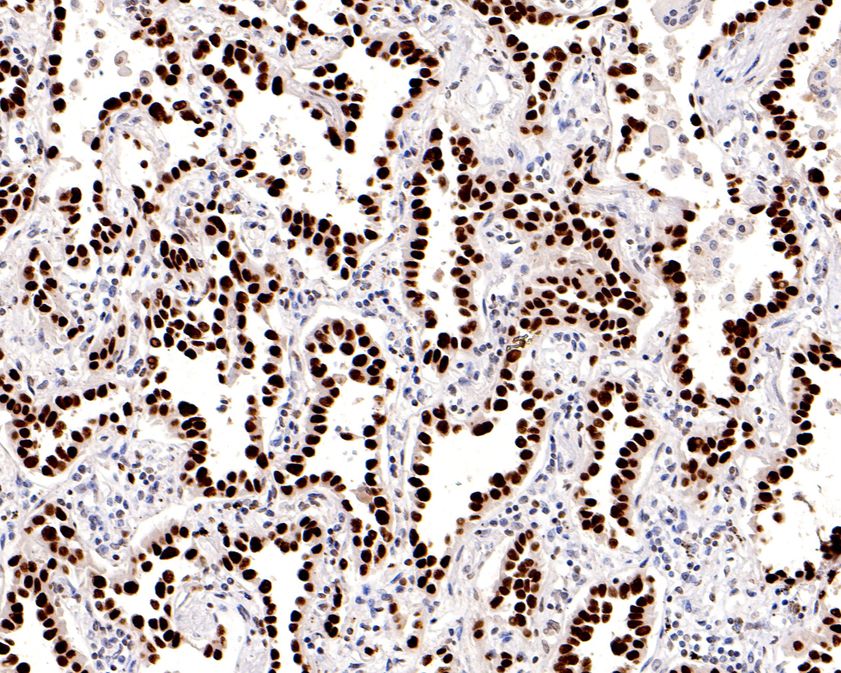 Immunohistochemical analysis of paraffin-embedded human thyroid carcinoma tissue using anti-TTF1 antibody. The section was pre-treated using heat mediated antigen retrieval with sodium citrate buffer (pH 6.0) for 20 minutes. The tissues were blocked in 5% BSA for 30 minutes at room temperature, washed with ddH2O and PBS, and then probed with the primary antibody (HA720067, 1/2,000)  for 30 minutes at room temperature. The detection was performed using an HRP conjugated compact polymer system. DAB was used as the chromogen. Tissues were counterstained with hematoxylin and mounted with DPX.