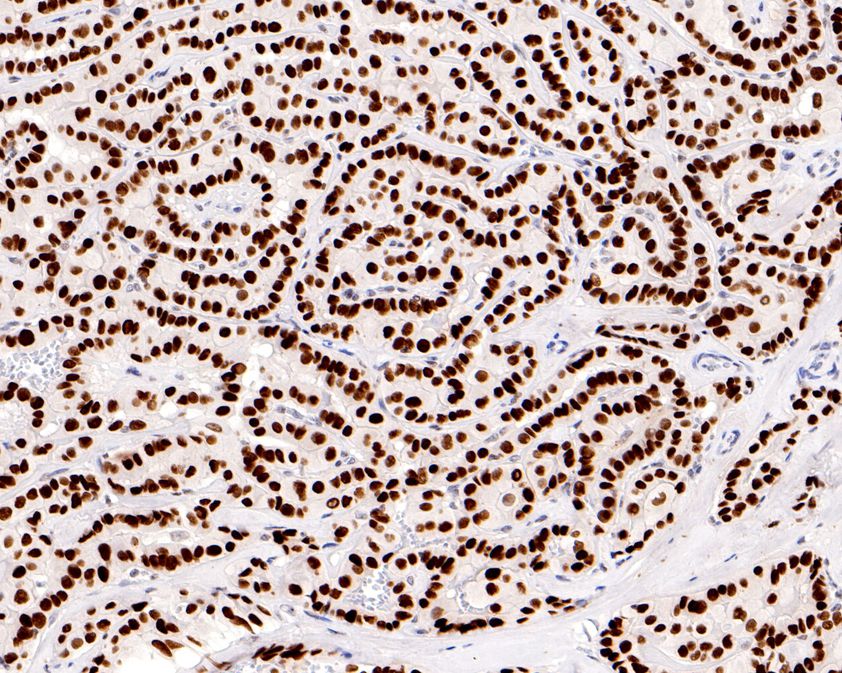 Immunohistochemical analysis of paraffin-embedded human thyroid tissue using anti-TTF1 antibody. The section was pre-treated using heat mediated antigen retrieval with sodium citrate buffer (pH 6.0) for 20 minutes. The tissues were blocked in 5% BSA for 30 minutes at room temperature, washed with ddH2O and PBS, and then probed with the primary antibody (HA720067, 1/2,000)  for 30 minutes at room temperature. The detection was performed using an HRP conjugated compact polymer system. DAB was used as the chromogen. Tissues were counterstained with hematoxylin and mounted with DPX.