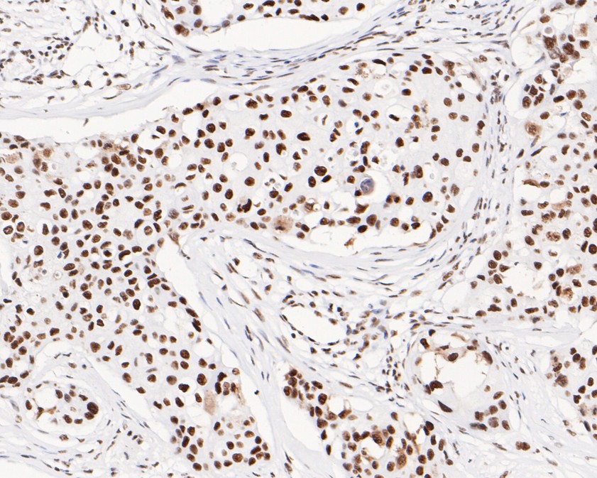 Immunohistochemical analysis of paraffin-embedded human breast carcinoma tissue using anti-USP39 antibody. The section was pre-treated using heat mediated antigen retrieval with sodium citrate buffer (pH 6.0) for 20 minutes. The tissues were blocked in 5% BSA for 30 minutes at room temperature, washed with ddH2O and PBS, and then probed with the primary antibody (HA720071, 1/200)  for 30 minutes at room temperature. The detection was performed using an HRP conjugated compact polymer system. DAB was used as the chromogen. Tissues were counterstained with hematoxylin and mounted with DPX.