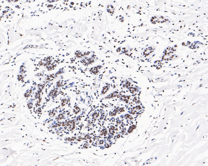 Immunohistochemical analysis of paraffin-embedded human breast tissue using anti-USP39 antibody. The section was pre-treated using heat mediated antigen retrieval with sodium citrate buffer (pH 6.0) for 20 minutes. The tissues were blocked in 5% BSA for 30 minutes at room temperature, washed with ddH2O and PBS, and then probed with the primary antibody (HA720071, 1/200)  for 30 minutes at room temperature. The detection was performed using an HRP conjugated compact polymer system. DAB was used as the chromogen. Tissues were counterstained with hematoxylin and mounted with DPX.