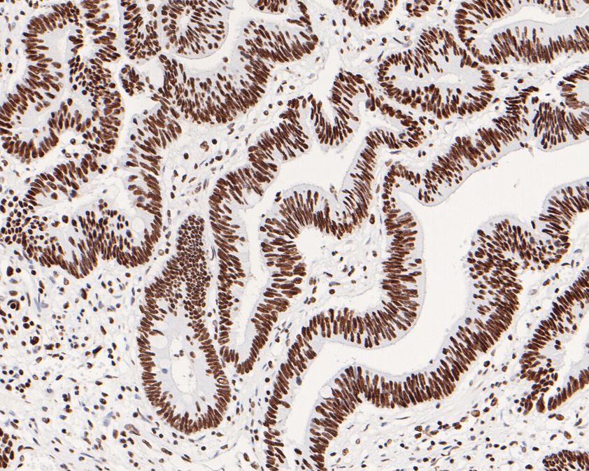 Immunohistochemical analysis of paraffin-embedded human colon carcinoma tissue using anti-USP39 antibody. The section was pre-treated using heat mediated antigen retrieval with sodium citrate buffer (pH 6.0) for 20 minutes. The tissues were blocked in 5% BSA for 30 minutes at room temperature, washed with ddH2O and PBS, and then probed with the primary antibody (HA720071, 1/200)  for 30 minutes at room temperature. The detection was performed using an HRP conjugated compact polymer system. DAB was used as the chromogen. Tissues were counterstained with hematoxylin and mounted with DPX.