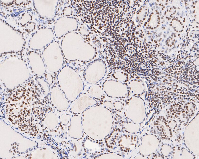 Immunohistochemical analysis of paraffin-embedded human thyroid tissue using anti-USP39 antibody. The section was pre-treated using heat mediated antigen retrieval with sodium citrate buffer (pH 6.0) for 20 minutes. The tissues were blocked in 5% BSA for 30 minutes at room temperature, washed with ddH2O and PBS, and then probed with the primary antibody (HA720071, 1/200)  for 30 minutes at room temperature. The detection was performed using an HRP conjugated compact polymer system. DAB was used as the chromogen. Tissues were counterstained with hematoxylin and mounted with DPX.