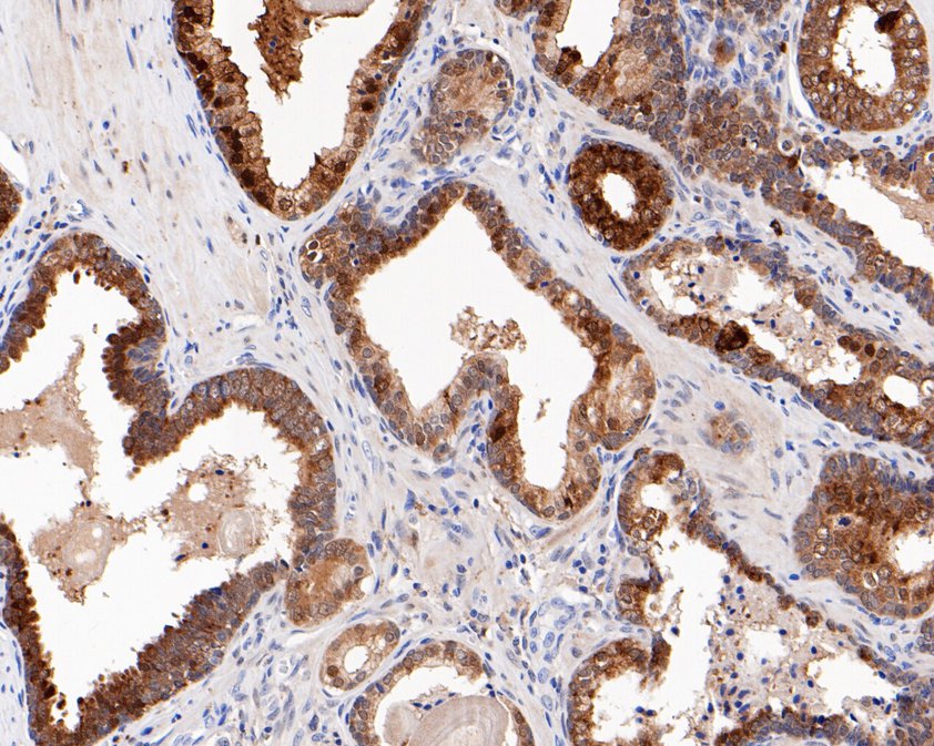 Immunohistochemical analysis of paraffin-embedded human prostate tissue using anti-Spermine synthase antibody. The section was pre-treated using heat mediated antigen retrieval with Tris-EDTA buffer (pH 9.0) for 20 minutes.The tissues were blocked in 5% BSA for 30 minutes at room temperature, washed with ddH2O and PBS, and then probed with the primary antibody (HA720065, 1/200) for 30 minutes at room temperature. The detection was performed using an HRP conjugated compact polymer system. DAB was used as the chromogen. Tissues were counterstained with hematoxylin and mounted with DPX.