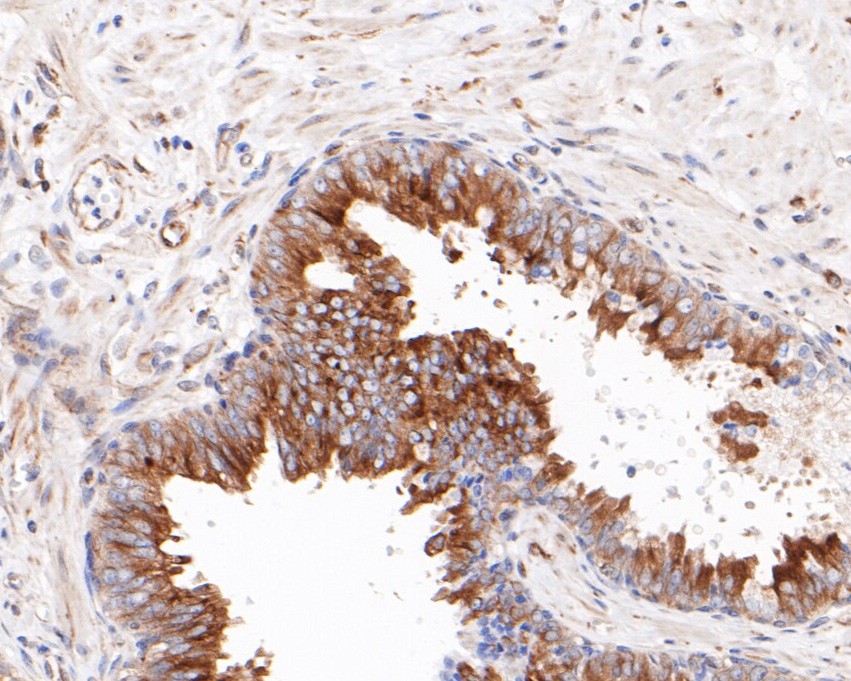Immunohistochemical analysis of paraffin-embedded human prostate tissue using anti-WDR68 antibody. The section was pre-treated using heat mediated antigen retrieval with sodium citrate buffer (pH 6.0) for 20 minutes. The tissues were blocked in 5% BSA for 30 minutes at room temperature, washed with ddH2O and PBS, and then probed with the primary antibody (HA720062, 1/200)  for 30 minutes at room temperature. The detection was performed using an HRP conjugated compact polymer system. DAB was used as the chromogen. Tissues were counterstained with hematoxylin and mounted with DPX.