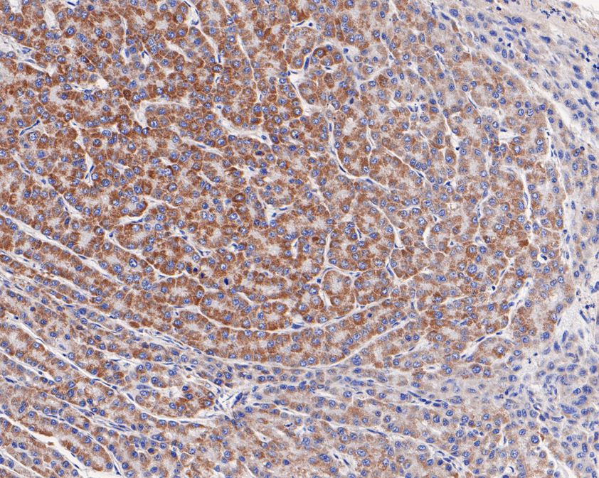Immunohistochemical analysis of paraffin-embedded human liver carcinoma tissue using anti-SAMM50 antibody. The section was pre-treated using heat mediated antigen retrieval with Tris-EDTA buffer (pH 9.0) for 20 minutes.The tissues were blocked in 5% BSA for 30 minutes at room temperature, washed with ddH2O and PBS, and then probed with the primary antibody (HA720059, 1/200) for 30 minutes at room temperature. The detection was performed using an HRP conjugated compact polymer system. DAB was used as the chromogen. Tissues were counterstained with hematoxylin and mounted with DPX.