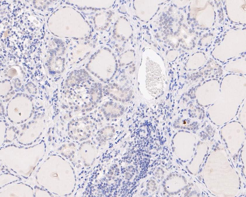 Immunohistochemical analysis of paraffin-embedded human thyroid tissue using anti-PIAS1 antibody. The section was pre-treated using heat mediated antigen retrieval with sodium citrate buffer (pH 6.0) for 20 minutes. The tissues were blocked in 5% BSA for 30 minutes at room temperature, washed with ddH2O and PBS, and then probed with the primary antibody (HA720076, 1/200)  for 30 minutes at room temperature. The detection was performed using an HRP conjugated compact polymer system. DAB was used as the chromogen. Tissues were counterstained with hematoxylin and mounted with DPX.