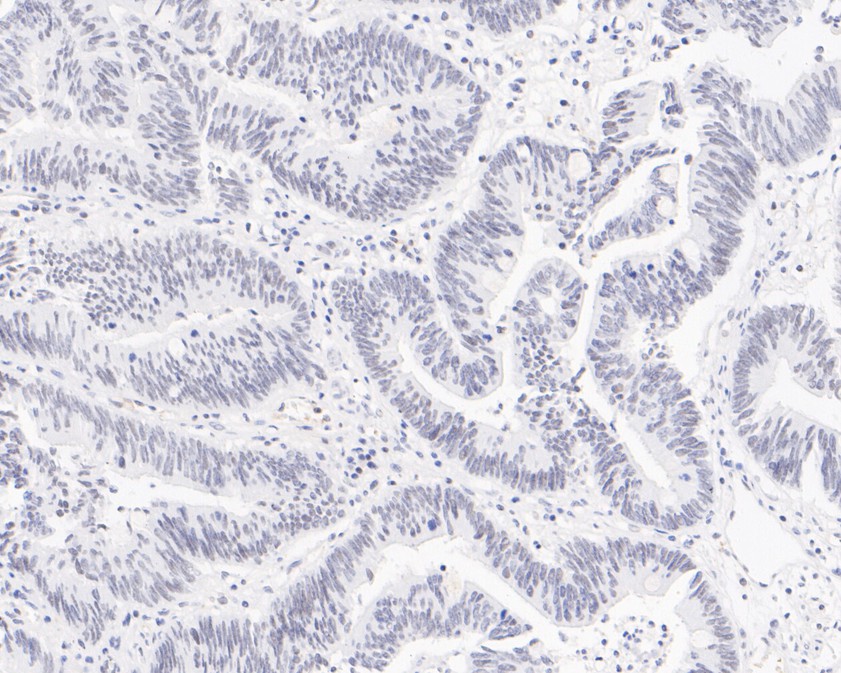 Immunohistochemical analysis of paraffin-embedded human colon carcinoma tissue using anti-PIAS1 antibody. The section was pre-treated using heat mediated antigen retrieval with sodium citrate buffer (pH 6.0) for 20 minutes. The tissues were blocked in 5% BSA for 30 minutes at room temperature, washed with ddH2O and PBS, and then probed with the primary antibody (HA720076, 1/200)  for 30 minutes at room temperature. The detection was performed using an HRP conjugated compact polymer system. DAB was used as the chromogen. Tissues were counterstained with hematoxylin and mounted with DPX.
