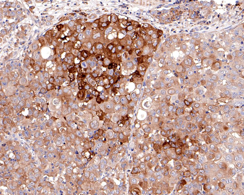 Immunohistochemical analysis of paraffin-embedded human lung carcinoma tissue using anti-Met (c-Met) antibody. The section was pre-treated using heat mediated antigen retrieval with Tris-EDTA buffer (pH 9.0) for 20 minutes.The tissues were blocked in 5% BSA for 30 minutes at room temperature, washed with ddH2O and PBS, and then probed with the primary antibody (HA500242, 1/400) for 30 minutes at room temperature. The detection was performed using an HRP conjugated compact polymer system. DAB was used as the chromogen. Tissues were counterstained with hematoxylin and mounted with DPX.