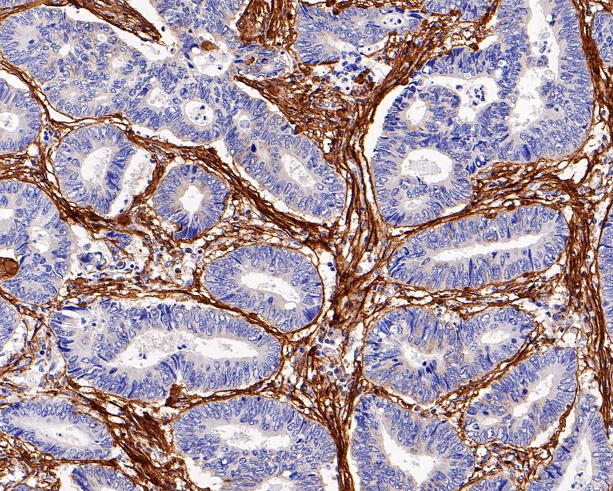 Immunohistochemical analysis of paraffin-embedded human colon carcinoma tissue with Rabbit anti-COL1A1 antibody (ET1609-68) at 1/1,000 dilution.<br />
<br />
The section was pre-treated using heat mediated antigen retrieval with sodium citrate buffer (pH 6.0) for 2 minutes. The tissues were blocked in 1% BSA for 20 minutes at room temperature, washed with ddH2O and PBS, and then probed with the primary antibody (ET1609-68) at 1/1,000 dilution for 1 hour at room temperature. The detection was performed using an HRP conjugated compact polymer system. DAB was used as the chromogen. Tissues were counterstained with hematoxylin and mounted with DPX.