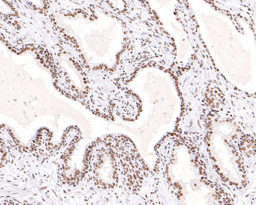 Immunohistochemical analysis of paraffin-embedded human prostate tissue using anti-ASPP2 antibody. The section was pre-treated using heat mediated antigen retrieval with sodium citrate buffer (pH 6.0) for 20 minutes. The tissues were blocked in 1% BSA for 30 minutes at room temperature, washed with ddH2O and PBS, and then probed with the primary antibody (ET1702-79, 1/100)  for 30 minutes at room temperature. The detection was performed using an HRP conjugated compact polymer system. DAB was used as the chromogen. Tissues were counterstained with hematoxylin and mounted with DPX.