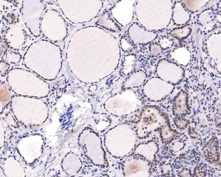Immunohistochemical analysis of paraffin-embedded human thyroid tissue using anti-WDR5 antibody. The section was pre-treated using heat mediated antigen retrieval with sodium citrate buffer (pH 6.0) for 20 minutes. The tissues were blocked in 1% BSA for 30 minutes at room temperature, washed with ddH2O and PBS, and then probed with the primary antibody (ET1705-60, 1/200)  for 30 minutes at room temperature. The detection was performed using an HRP conjugated compact polymer system. DAB was used as the chromogen. Tissues were counterstained with hematoxylin and mounted with DPX.