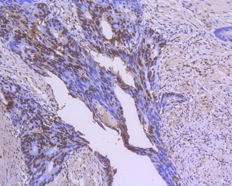 Immunohistochemical analysis of paraffin-embedded human colon carcinoma tissue using anti-GATA4 antibody. The section was pre-treated using heat mediated antigen retrieval with Tris-EDTA buffer (pH 9.0) for 20 minutes.The tissues were blocked in 1% BSA for 30 minutes at room temperature, washed with ddH2O and PBS, and then probed with the primary antibody (M1306-2, 1/50) for 30 minutes at room temperature. The detection was performed using an HRP conjugated compact polymer system. DAB was used as the chromogen. Tissues were counterstained with hematoxylin and mounted with DPX.