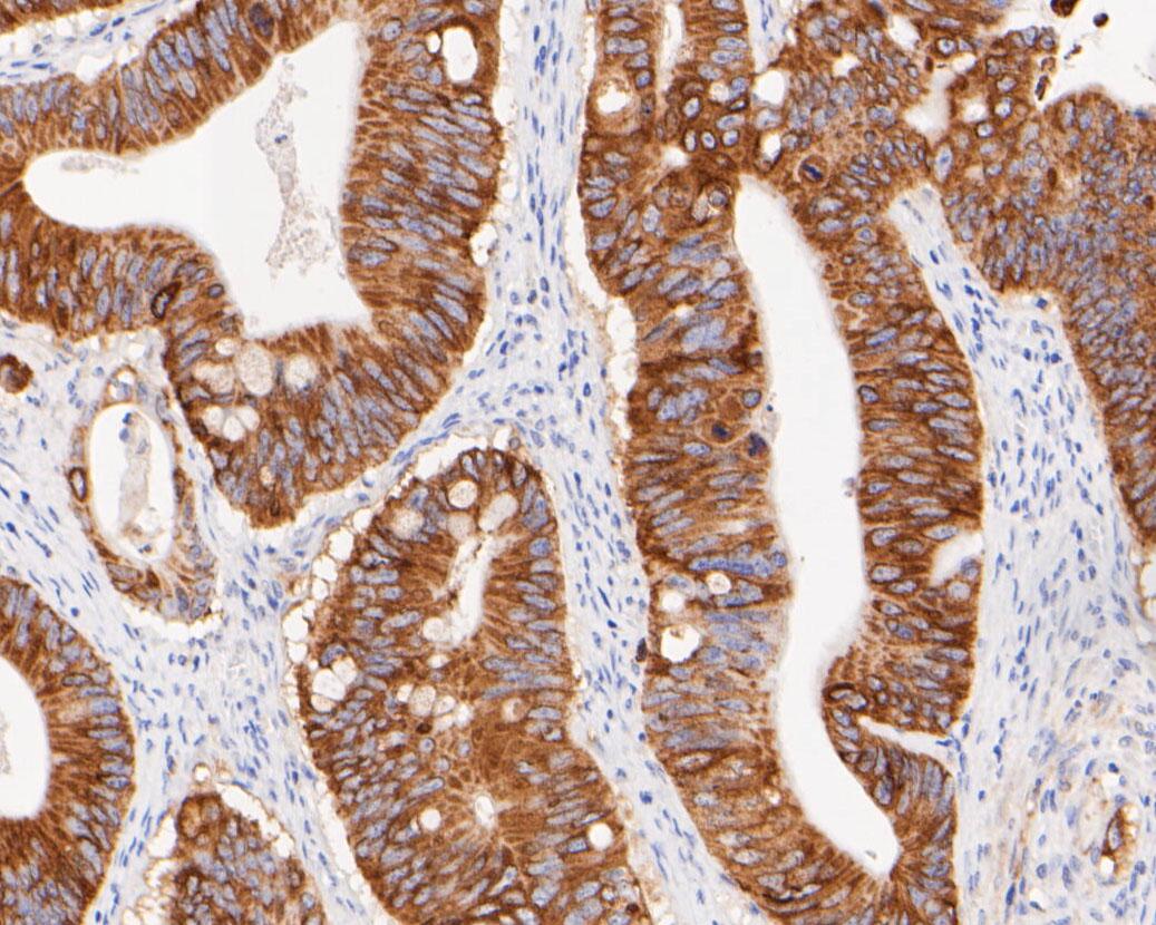 Immunohistochemical analysis of paraffin-embedded human Colon cancer tissue using anti-FAT1 antibody. The section was pre-treated using heat mediated antigen retrieval with sodium citrate buffer (pH 6.0) for 20 minutes. The tissues were blocked in 5% BSA for 30 minutes at room temperature, washed with ddH2O and PBS, and then probed with the primary antibody (0905-4, 1/100) for 1 hour at room temperature. The detection was performed using an HRP conjugated compact polymer system. DAB was used as the chromogen. Tissues were counterstained with hematoxylin and mounted with DPX.