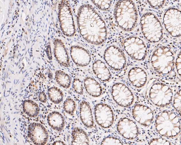 Immunohistochemical analysis of paraffin-embedded human colon tissue using anti-HMGB2 antibody. The section was pre-treated using heat mediated antigen retrieval with sodium citrate buffer (pH 6.0) for 20 minutes. The tissues were blocked in 5% BSA for 30 minutes at room temperature, washed with ddH2O and PBS, and then probed with the primary antibody (HA500512, 1/200)  for 30 minutes at room temperature. The detection was performed using an HRP conjugated compact polymer system. DAB was used as the chromogen. Tissues were counterstained with hematoxylin and mounted with DPX.