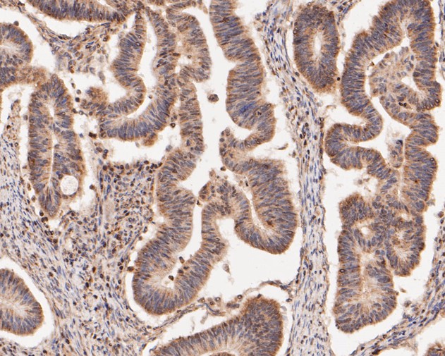 Immunohistochemical analysis of paraffin-embedded human colon carcinoma tissue using anti-HMGB2 antibody. The section was pre-treated using heat mediated antigen retrieval with sodium citrate buffer (pH 6.0) for 20 minutes. The tissues were blocked in 5% BSA for 30 minutes at room temperature, washed with ddH2O and PBS, and then probed with the primary antibody (HA500512, 1/50)  for 30 minutes at room temperature. The detection was performed using an HRP conjugated compact polymer system. DAB was used as the chromogen. Tissues were counterstained with hematoxylin and mounted with DPX.