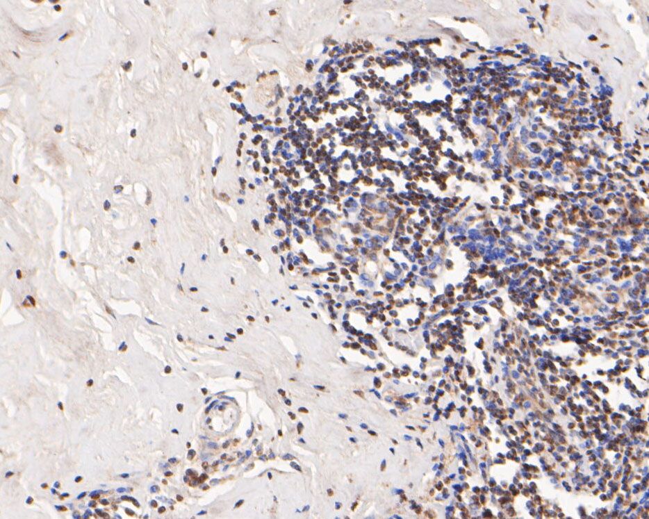 Immunohistochemical analysis of paraffin-embedded human breast cancer tissue using anti-Histone H3 antibody. The section was pre-treated using heat mediated antigen retrieval with sodium citrate buffer (pH 6.0) for 20 minutes. The tissues were blocked in 5% BSA for 30 minutes at room temperature, washed with ddH2O and PBS, and then probed with the primary antibody (HA500298, 1/400)  for 30 minutes at room temperature. The detection was performed using an HRP conjugated compact polymer system. DAB was used as the chromogen. Tissues were counterstained with hematoxylin and mounted with DPX.