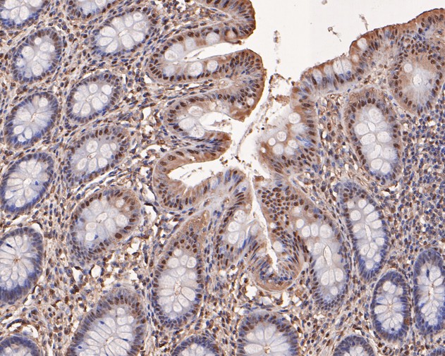 Immunohistochemical analysis of paraffin-embedded human colon tissue using anti-Triosephosphate isomerase antibody. The section was pre-treated using heat mediated antigen retrieval with sodium citrate buffer (pH 6.0) for 20 minutes. The tissues were blocked in 5% BSA for 30 minutes at room temperature, washed with ddH2O and PBS, and then probed with the primary antibody (HA500283, 1/400)  for 30 minutes at room temperature. The detection was performed using an HRP conjugated compact polymer system. DAB was used as the chromogen. Tissues were counterstained with hematoxylin and mounted with DPX.