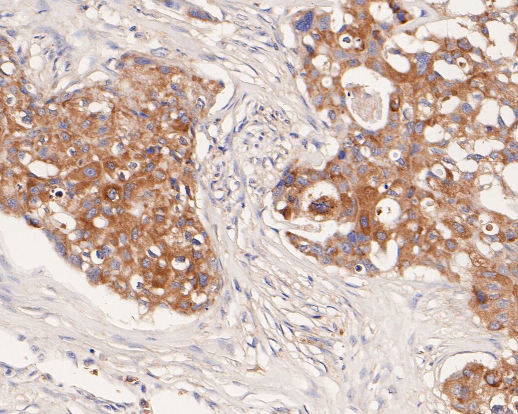Immunohistochemical analysis of paraffin-embedded human breast carcinoma tissue using anti-CX3CL1 antibody. The section was pre-treated using heat mediated antigen retrieval with Tris-EDTA buffer (pH 9.0) for 20 minutes.The tissues were blocked in 5% BSA for 30 minutes at room temperature, washed with ddH2O and PBS, and then probed with the primary antibody (HA500304, 1/200) for 30 minutes at room temperature. The detection was performed using an HRP conjugated compact polymer system. DAB was used as the chromogen. Tissues were counterstained with hematoxylin and mounted with DPX.