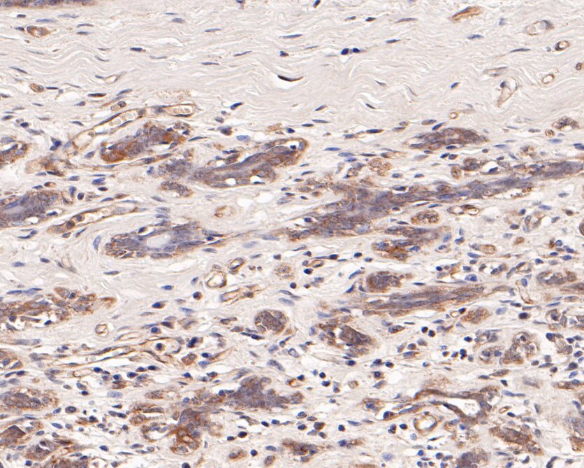 Immunohistochemical analysis of paraffin-embedded human breast carcinoma tissue using anti-TCP1 delta antibody. The section was pre-treated using heat mediated antigen retrieval with Tris-EDTA buffer (pH 9.0) for 20 minutes.The tissues were blocked in 5% BSA for 30 minutes at room temperature, washed with ddH2O and PBS, and then probed with the primary antibody (HA500308, 1/400) for 30 minutes at room temperature. The detection was performed using an HRP conjugated compact polymer system. DAB was used as the chromogen. Tissues were counterstained with hematoxylin and mounted with DPX.
