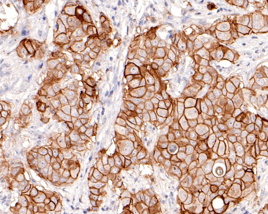 Immunohistochemical analysis of paraffin-embedded human breast cancer tissue using anti-TROP2 antibody. The section was pre-treated using heat mediated antigen retrieval with sodium citrate buffer (pH 6.0) for 20 minutes. The tissues were blocked in 1% BSA for 30 minutes at room temperature, washed with ddH2O and PBS, and then probed with the primary antibody (HA600069, 1/400)  for 30 minutes at room temperature. The detection was performed using an HRP conjugated compact polymer system. DAB was used as the chromogen. Tissues were counterstained with hematoxylin and mounted with DPX.