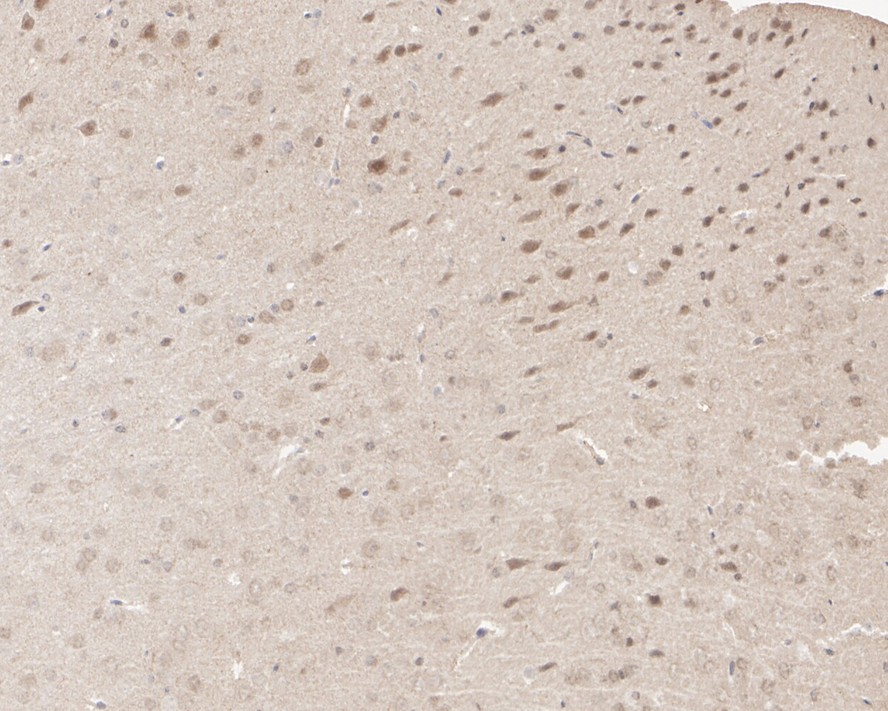 Immunohistochemical analysis of paraffin-embedded human colon carcinoma tissue using anti-SF3A1 antibody. The section was pre-treated using heat mediated antigen retrieval with sodium citrate buffer (pH 6.0) for 20 minutes. The tissues were blocked in 1% BSA for 30 minutes at room temperature, washed with ddH2O and PBS, and then probed with the primary antibody (HA500235, 1/200)  for 30 minutes at room temperature. The detection was performed using an HRP conjugated compact polymer system. DAB was used as the chromogen. Tissues were counterstained with hematoxylin and mounted with DPX.