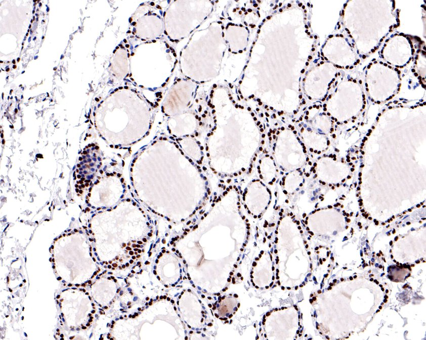 Immunohistochemical analysis of paraffin-embedded human thyroid tissue using anti-RAD52 antibody. The section was pre-treated using heat mediated antigen retrieval with sodium citrate buffer (pH 6.0) for 20 minutes. The tissues were blocked in 1% BSA for 30 minutes at room temperature, washed with ddH2O and PBS, and then probed with the primary antibody (HA500483, 1/600)  for 30 minutes at room temperature. The detection was performed using an HRP conjugated compact polymer system. DAB was used as the chromogen. Tissues were counterstained with hematoxylin and mounted with DPX.