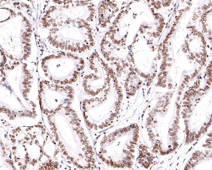 Immunohistochemical analysis of paraffin-embedded human colon carcinoma tissue using anti-RAD52 antibody. The section was pre-treated using heat mediated antigen retrieval with sodium citrate buffer (pH 6.0) for 20 minutes. The tissues were blocked in 1% BSA for 30 minutes at room temperature, washed with ddH2O and PBS, and then probed with the primary antibody (HA500483, 1/600)  for 30 minutes at room temperature. The detection was performed using an HRP conjugated compact polymer system. DAB was used as the chromogen. Tissues were counterstained with hematoxylin and mounted with DPX.