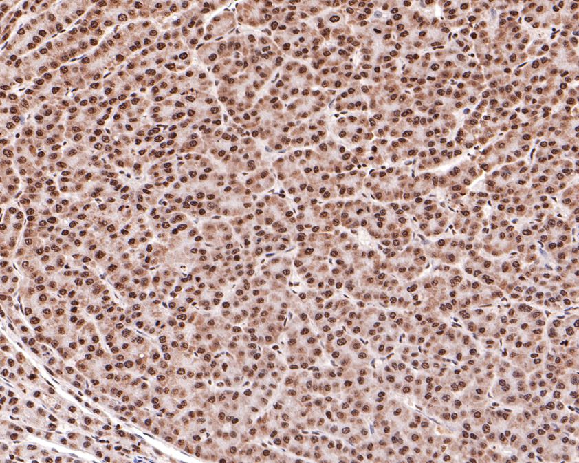 Immunohistochemical analysis of paraffin-embedded human liver carcinoma tissue using anti-RAD52 antibody. The section was pre-treated using heat mediated antigen retrieval with sodium citrate buffer (pH 6.0) for 20 minutes. The tissues were blocked in 1% BSA for 30 minutes at room temperature, washed with ddH2O and PBS, and then probed with the primary antibody (HA500483, 1/600)  for 30 minutes at room temperature. The detection was performed using an HRP conjugated compact polymer system. DAB was used as the chromogen. Tissues were counterstained with hematoxylin and mounted with DPX.