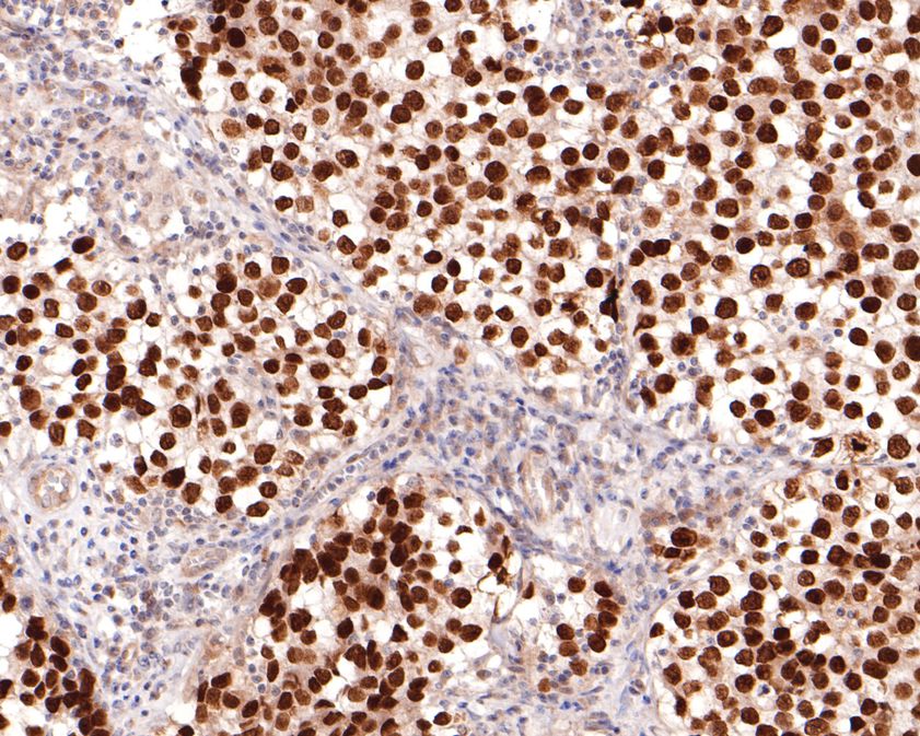 Immunohistochemical analysis of paraffin-embedded human seminoma tissue using anti-Sall4 antibody. The section was pre-treated using heat mediated antigen retrieval with sodium citrate buffer (pH 6.0) for 20 minutes. The tissues were blocked in 1% BSA for 30 minutes at room temperature, washed with ddH2O and PBS, and then probed with the primary antibody (HA500482, 1/600)  for 30 minutes at room temperature. The detection was performed using an HRP conjugated compact polymer system. DAB was used as the chromogen. Tissues were counterstained with hematoxylin and mounted with DPX.