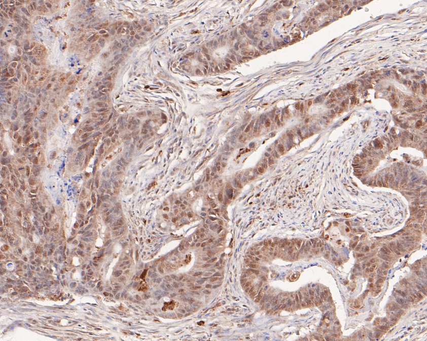 Immunohistochemical analysis of paraffin-embedded human colon carcinoma tissue using anti-p107 antibody. The section was pre-treated using heat mediated antigen retrieval with sodium citrate buffer (pH 6.0) for 20 minutes. The tissues were blocked in 1% BSA for 30 minutes at room temperature, washed with ddH2O and PBS, and then probed with the primary antibody (HA500481, 1/400)  for 30 minutes at room temperature. The detection was performed using an HRP conjugated compact polymer system. DAB was used as the chromogen. Tissues were counterstained with hematoxylin and mounted with DPX.