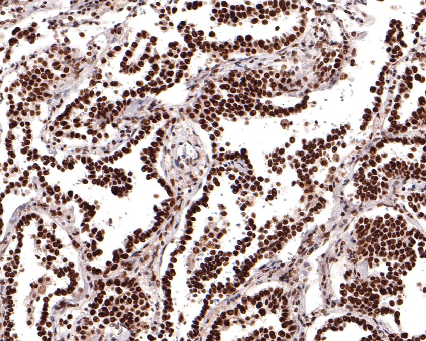 Immunohistochemical analysis of paraffin-embedded human lung carcinoma tissue using anti-DPF2 antibody. The section was pre-treated using heat mediated antigen retrieval with sodium citrate buffer (pH 6.0) for 20 minutes. The tissues were blocked in 1% BSA for 30 minutes at room temperature, washed with ddH2O and PBS, and then probed with the primary antibody (HA720105, 1/400)  for 30 minutes at room temperature. The detection was performed using an HRP conjugated compact polymer system. DAB was used as the chromogen. Tissues were counterstained with hematoxylin and mounted with DPX.