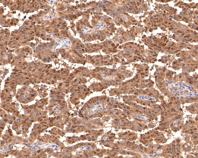 Immunohistochemical analysis of paraffin-embedded human ovarian carcinoma tissue using anti-ALS2CR1 antibody. The section was pre-treated using heat mediated antigen retrieval with sodium citrate buffer (pH 6.0) for 20 minutes. The tissues were blocked in 1% BSA for 30 minutes at room temperature, washed with ddH2O and PBS, and then probed with the primary antibody (HA720111, 1/50)  for 30 minutes at room temperature. The detection was performed using an HRP conjugated compact polymer system. DAB was used as the chromogen. Tissues were counterstained with hematoxylin and mounted with DPX.