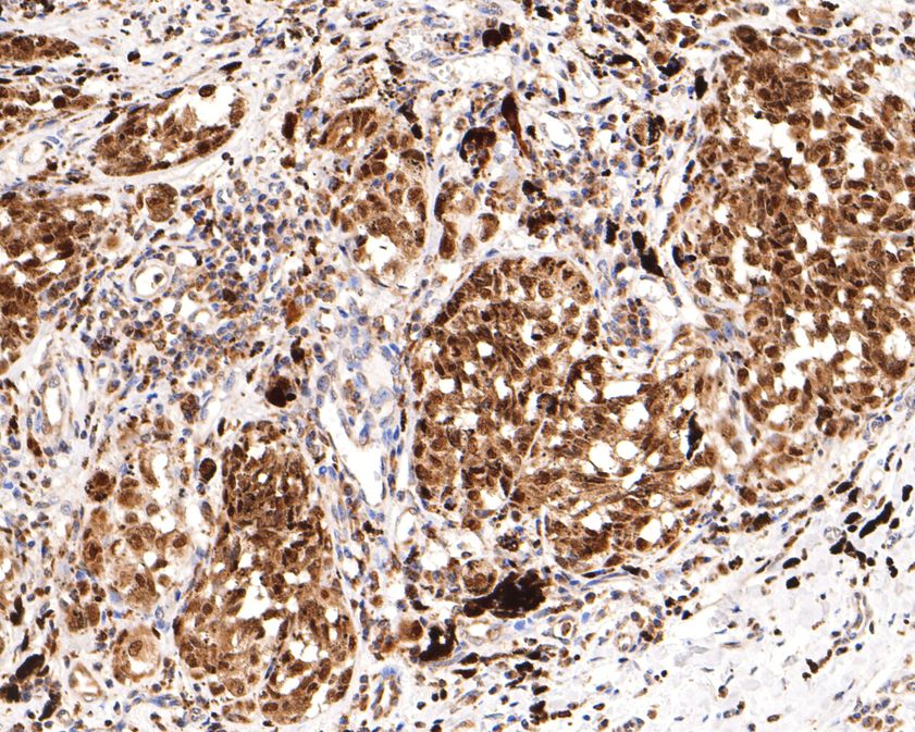 Immunohistochemical analysis of paraffin-embedded human malignant melanoma tissue using anti-SOX10 antibody. The section was pre-treated using heat mediated antigen retrieval with sodium citrate buffer (pH 6.0) for 20 minutes. The tissues were blocked in 1% BSA for 30 minutes at room temperature, washed with ddH2O and PBS, and then probed with the primary antibody (HA500503, 1/600)  for 30 minutes at room temperature. The detection was performed using an HRP conjugated compact polymer system. DAB was used as the chromogen. Tissues were counterstained with hematoxylin and mounted with DPX.