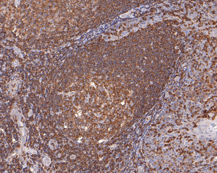 Immunohistochemical analysis of paraffin-embedded human tonsil tissue using anti-WASP/Wiskott-Aldrich syndrome protein antibody. The section was pre-treated using heat mediated antigen retrieval with sodium citrate buffer (pH 6.0) for 20 minutes. The tissues were blocked in 1% BSA for 30 minutes at room temperature, washed with ddH2O and PBS, and then probed with the primary antibody (HA500490, 1/600)  for 30 minutes at room temperature. The detection was performed using an HRP conjugated compact polymer system. DAB was used as the chromogen. Tissues were counterstained with hematoxylin and mounted with DPX.