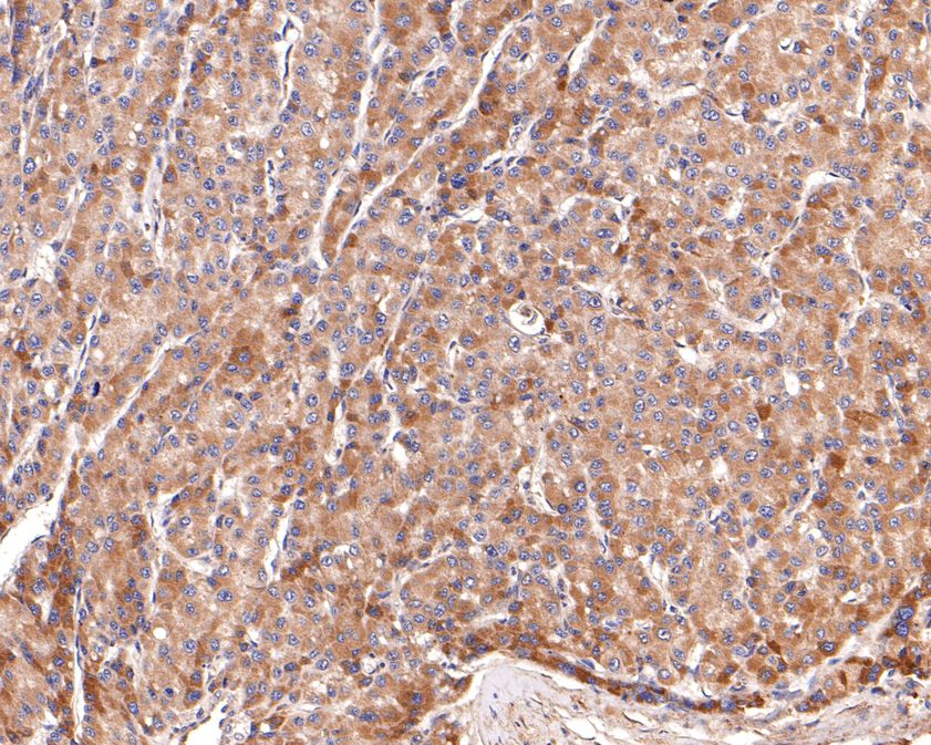 Immunohistochemical analysis of paraffin-embedded human liver carcinoma tissue using anti-Aldehyde Oxidase antibody. The section was pre-treated using heat mediated antigen retrieval with Tris-EDTA buffer (pH 9.0) for 20 minutes.The tissues were blocked in 1% BSA for 30 minutes at room temperature, washed with ddH2O and PBS, and then probed with the primary antibody (HA500504, 1/200) for 30 minutes at room temperature. The detection was performed using an HRP conjugated compact polymer system. DAB was used as the chromogen. Tissues were counterstained with hematoxylin and mounted with DPX.