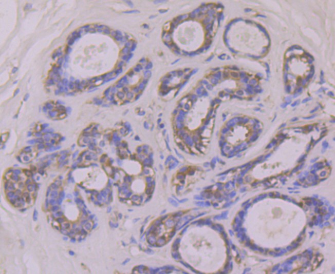 Immunohistochemical analysis of paraffin-embedded human breast cancer tissue using anti-PKM2 antibody. Counter stained with hematoxylin.