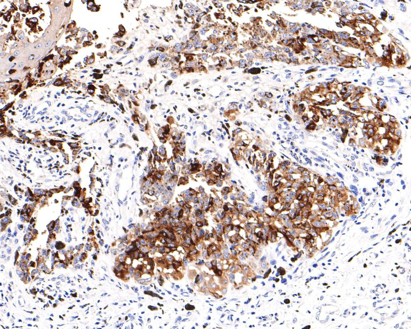Immunohistochemical analysis of paraffin-embedded human malignant melanoma tissue using anti-TRP1 antibody. The section was pre-treated using heat mediated antigen retrieval with Tris-EDTA buffer (pH 9.0) for 20 minutes.The tissues were blocked in 1% BSA for 30 minutes at room temperature, washed with ddH2O and PBS, and then probed with the primary antibody (ET7106-66, 1/400) for 30 minutes at room temperature. The detection was performed using an HRP conjugated compact polymer system. DAB was used as the chromogen. Tissues were counterstained with hematoxylin and mounted with DPX.