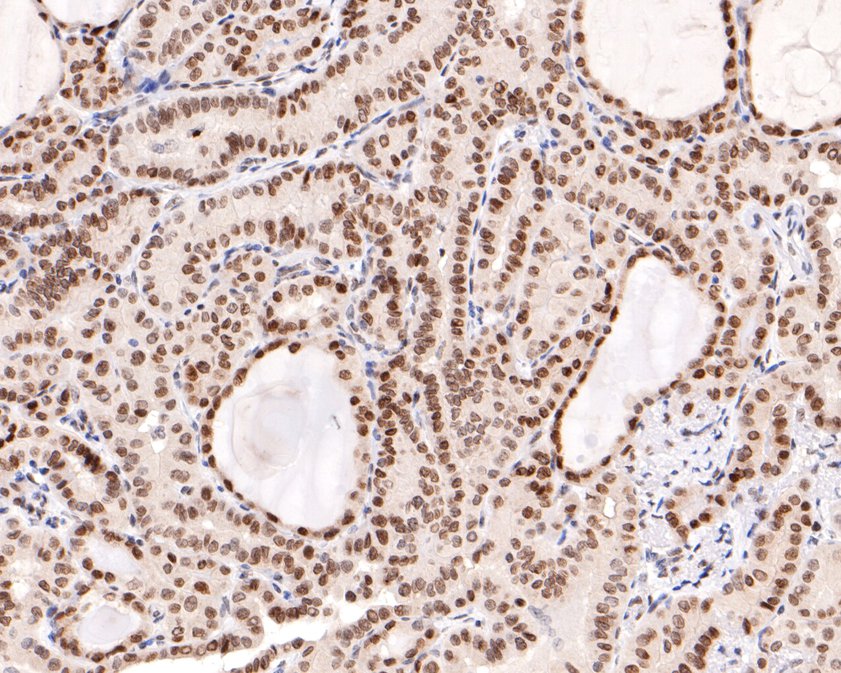 Immunohistochemical analysis of paraffin-embedded human thyroid carcinoma tissue using anti-BANF1 antibody. The section was pre-treated using heat mediated antigen retrieval with sodium citrate buffer (pH 6.0) for 20 minutes. The tissues were blocked in 1% BSA for 30 minutes at room temperature, washed with ddH2O and PBS, and then probed with the primary antibody (ET7109-08, 1/400)  for 30 minutes at room temperature. The detection was performed using an HRP conjugated compact polymer system. DAB was used as the chromogen. Tissues were counterstained with hematoxylin and mounted with DPX.