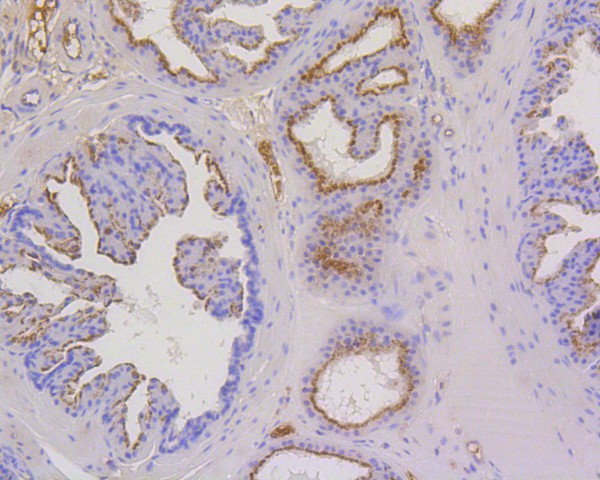 Immunohistochemical analysis of paraffin-embedded human prostate tissue using anti-Cytokeratin 17 antibody. The section was pre-treated using heat mediated antigen retrieval with Tris-EDTA buffer (pH 9.0) for 20 minutes.The tissues were blocked in 5% BSA for 30 minutes at room temperature, washed with ddH2O and PBS, and then probed with the primary antibody (ET1602-16, 1/400) for 30 minutes at room temperature. The detection was performed using an HRP conjugated compact polymer system. DAB was used as the chromogen. Tissues were counterstained with hematoxylin and mounted with DPX.