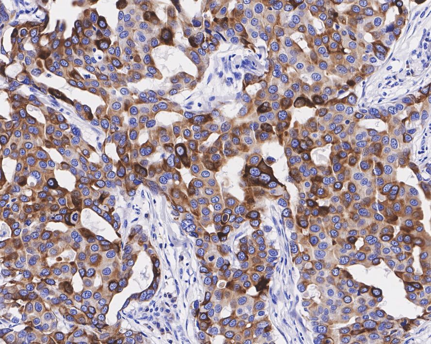 Immunohistochemical analysis of paraffin-embedded human breast carcinoma tissue with Rabbit anti-Cytokeratin 15 antibody (ET1609-54) at 1/400 dilution.<br />
<br />
The section was pre-treated using heat mediated antigen retrieval with Tris-EDTA buffer (pH 9.0) for 20 minutes. The tissues were blocked in 1% BSA for 20 minutes at room temperature, washed with ddH2O and PBS, and then probed with the primary antibody (ET1609-54) at 1/400 dilution for 1 hour at room temperature. The detection was performed using an HRP conjugated compact polymer system. DAB was used as the chromogen. Tissues were counterstained with hematoxylin and mounted with DPX.