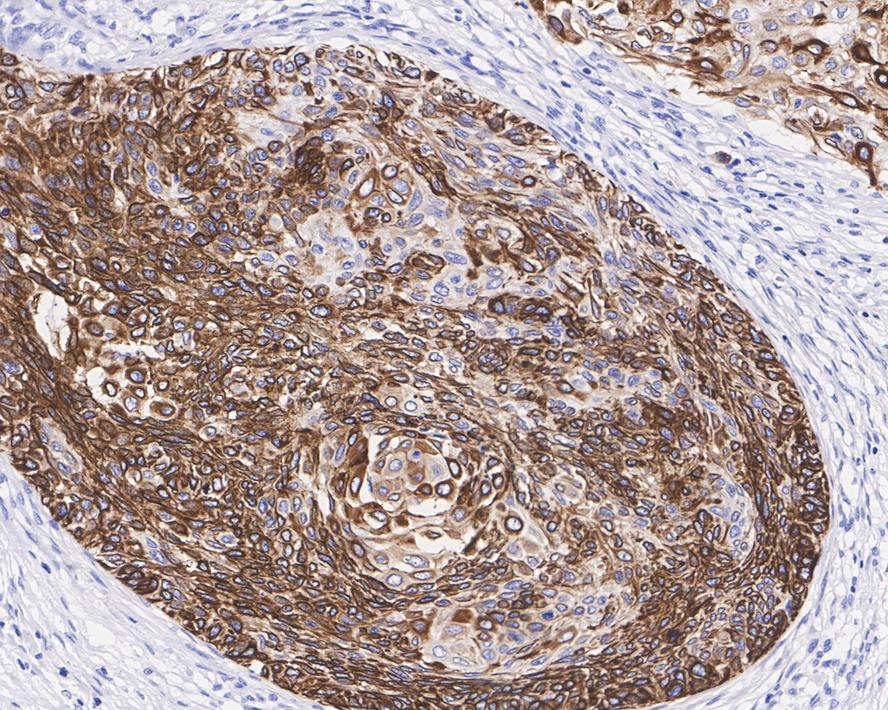 Immunohistochemical analysis of paraffin-embedded human cervical carcinoma tissue with Rabbit anti-Cytokeratin 15 antibody (ET1609-54) at 1/1,500 dilution.<br />
<br />
The section was pre-treated using heat mediated antigen retrieval with Tris-EDTA buffer (pH 9.0) for 20 minutes. The tissues were blocked in 1% BSA for 20 minutes at room temperature, washed with ddH2O and PBS, and then probed with the primary antibody (ET1609-54) at 1/1,500 dilution for 1 hour at room temperature. The detection was performed using an HRP conjugated compact polymer system. DAB was used as the chromogen. Tissues were counterstained with hematoxylin and mounted with DPX.