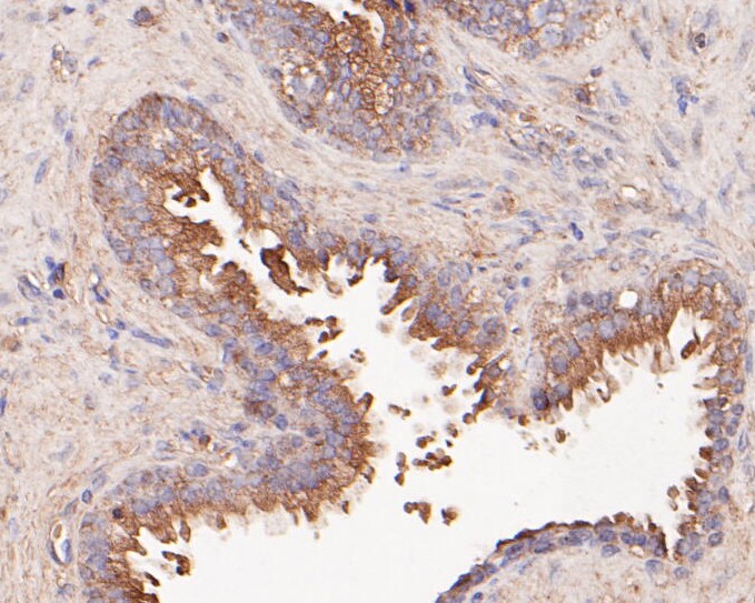 Immunohistochemical analysis of paraffin-embedded human prostate tissue using anti-Butyrylcholine esterase antibody. The section was pre-treated using heat mediated antigen retrieval with Tris-EDTA buffer (pH 8.0-8.4) for 20 minutes.The tissues were blocked in 5% BSA for 30 minutes at room temperature, washed with ddH2O and PBS, and then probed with the primary antibody (HA500248, 1/100) for 30 minutes at room temperature. The detection was performed using an HRP conjugated compact polymer system. DAB was used as the chromogen. Tissues were counterstained with hematoxylin and mounted with DPX.