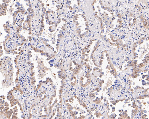 Immunohistochemical analysis of paraffin-embedded human lung carcinoma tissue using anti-UBE4B antibody. The section was pre-treated using heat mediated antigen retrieval with sodium citrate buffer (pH 6.0) for 20 minutes. The tissues were blocked in 5% BSA for 30 minutes at room temperature, washed with ddH2O and PBS, and then probed with the primary antibody (ET7111-11, 1/200)  for 30 minutes at room temperature. The detection was performed using an HRP conjugated compact polymer system. DAB was used as the chromogen. Tissues were counterstained with hematoxylin and mounted with DPX.