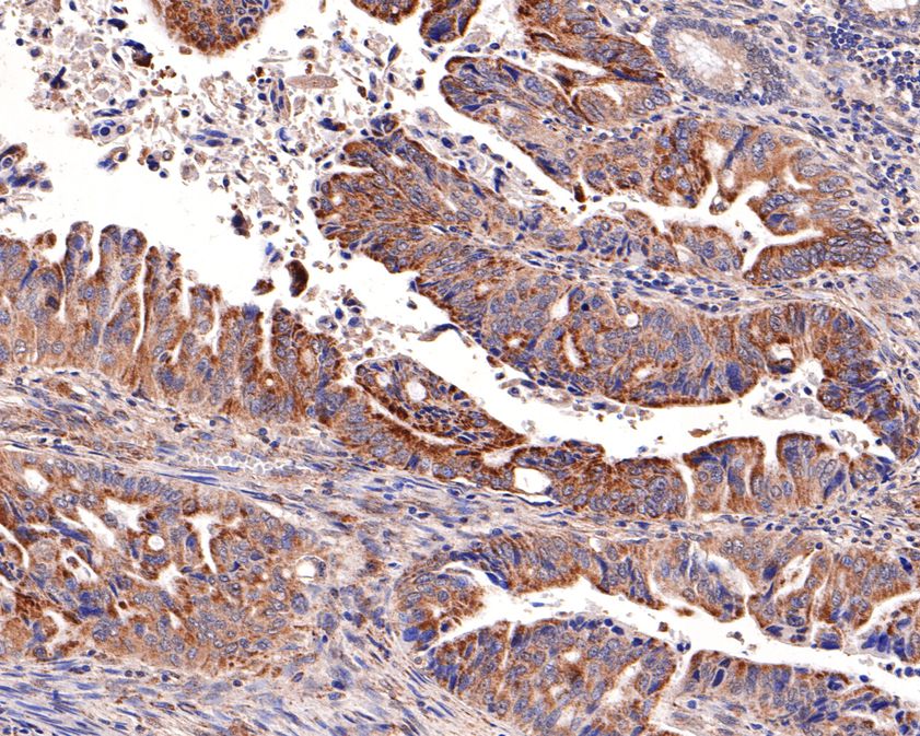 Immunohistochemical analysis of paraffin-embedded human colon carcinoma tissue using anti-SOCS4 antibody. The section was pre-treated using heat mediated antigen retrieval with Tris-EDTA buffer (pH 9.0) for 20 minutes.The tissues were blocked in 1% BSA for 30 minutes at room temperature, washed with ddH2O and PBS, and then probed with the primary antibody (HA500307, 1/200) for 30 minutes at room temperature. The detection was performed using an HRP conjugated compact polymer system. DAB was used as the chromogen. Tissues were counterstained with hematoxylin and mounted with DPX.