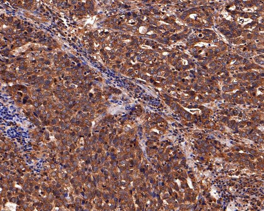 Immunohistochemical analysis of paraffin-embedded human stomach carcinoma tissue using anti-IL-5RA antibody. The section was pre-treated using heat mediated antigen retrieval with Tris-EDTA buffer (pH 9.0) for 20 minutes.The tissues were blocked in 1% BSA for 30 minutes at room temperature, washed with ddH2O and PBS, and then probed with the primary antibody (HA500303, 1/200) for 30 minutes at room temperature. The detection was performed using an HRP conjugated compact polymer system. DAB was used as the chromogen. Tissues were counterstained with hematoxylin and mounted with DPX.