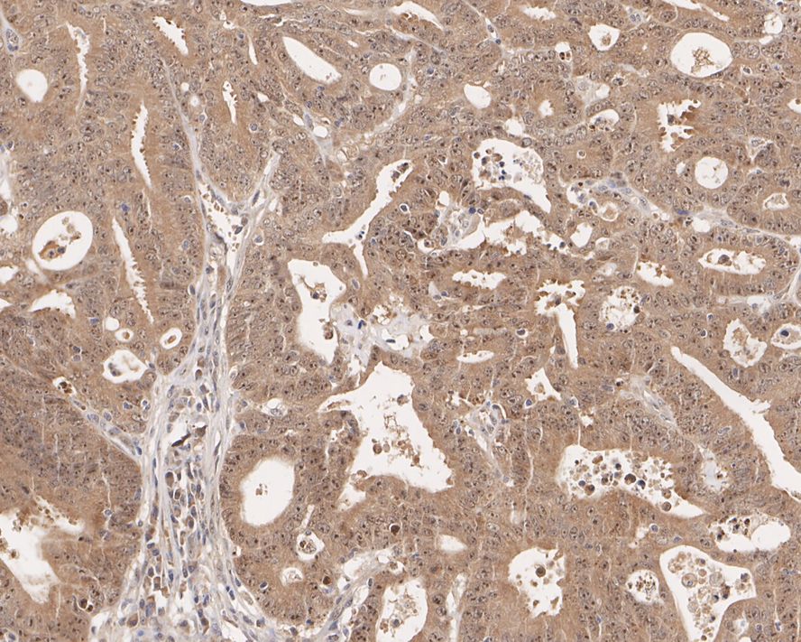 Immunohistochemical analysis of paraffin-embedded human colon cancer tissue with Mouse anti-eIF-6 antibody (HA600052) at 1/200 dilution.<br />
<br />
The section was pre-treated using heat mediated antigen retrieval with sodium citrate buffer (pH 6.0) for 2 minutes. The tissues were blocked in 1% BSA for 20 minutes at room temperature, washed with ddH2O and PBS, and then probed with the primary antibody (HA600052) at 1/200 dilution for 1 hour at room temperature. The detection was performed using an HRP conjugated compact polymer system. DAB was used as the chromogen. Tissues were counterstained with hematoxylin and mounted with DPX.