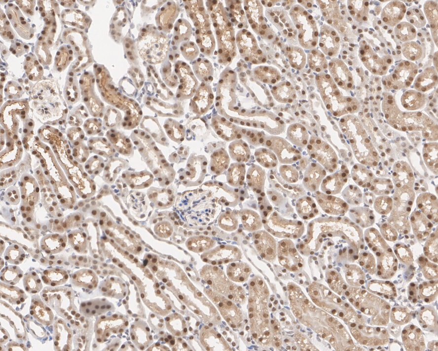 Immunohistochemical analysis of paraffin-embedded human ovarian carcinoma tissue using anti-eIF-6 antibody. The section was pre-treated using heat mediated antigen retrieval with sodium citrate buffer (pH 6.0) for 20 minutes. The tissues were blocked in 1% BSA for 30 minutes at room temperature, washed with ddH2O and PBS, and then probed with the primary antibody (HA600051, 1/600)  for 30 minutes at room temperature. The detection was performed using an HRP conjugated compact polymer system. DAB was used as the chromogen. Tissues were counterstained with hematoxylin and mounted with DPX.