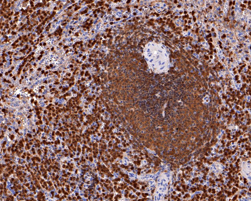 Immunohistochemical analysis of paraffin-embedded human lung tissue using anti-p47-phox antibody. The section was pre-treated using heat mediated antigen retrieval with Tris-EDTA buffer (pH 9.0) for 20 minutes.The tissues were blocked in 1% BSA for 30 minutes at room temperature, washed with ddH2O and PBS, and then probed with the primary antibody (HA600049, 1/1,000) for 30 minutes at room temperature. The detection was performed using an HRP conjugated compact polymer system. DAB was used as the chromogen. Tissues were counterstained with hematoxylin and mounted with DPX.